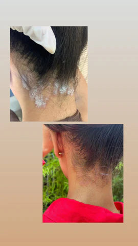 Ungüento para psoriasis y eccema Hair And Nature